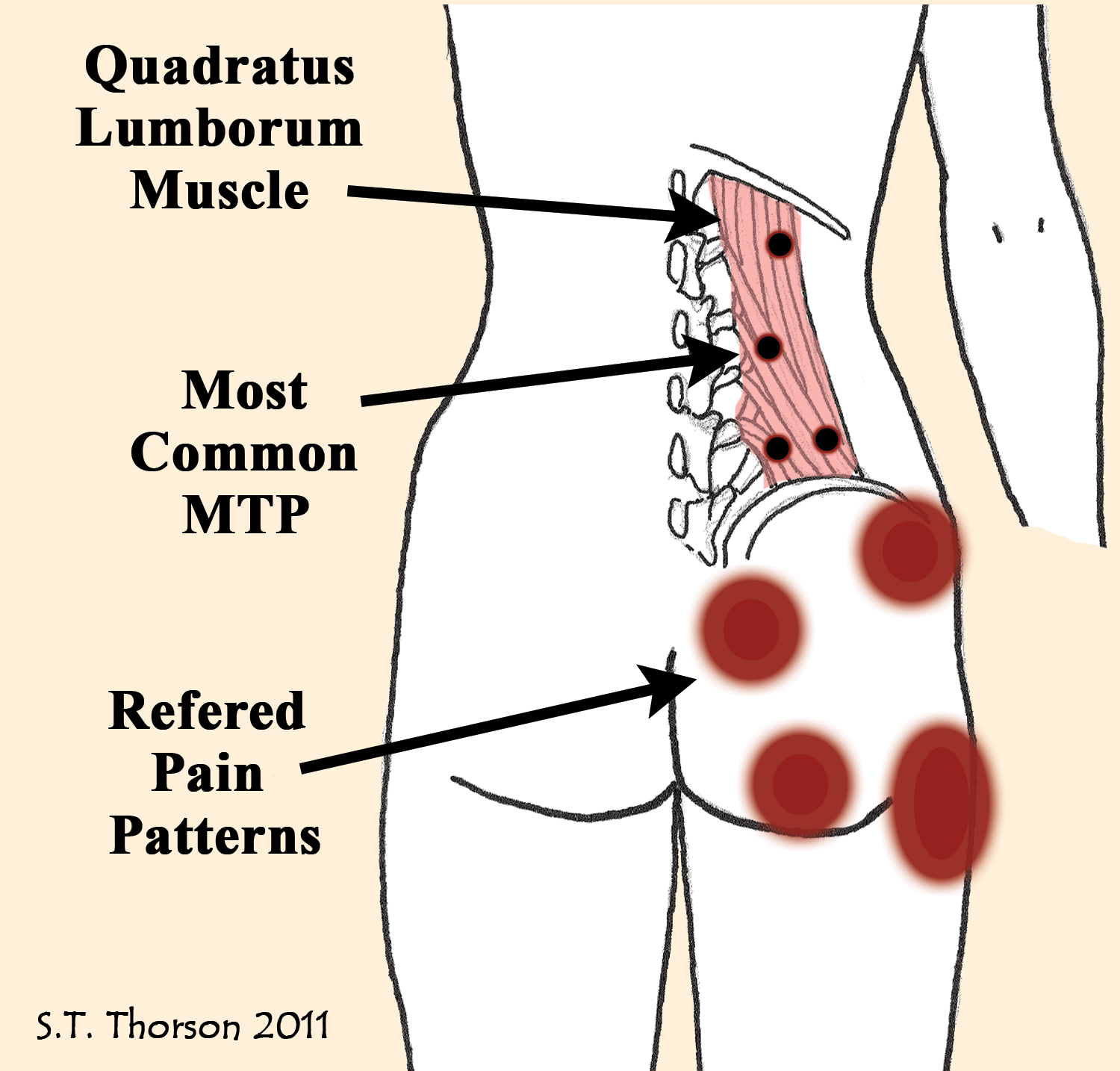 Diagram showing that trigger points in the quadratus lumborum muscle were not part of the tender point diagnosis in fibromyalgia.