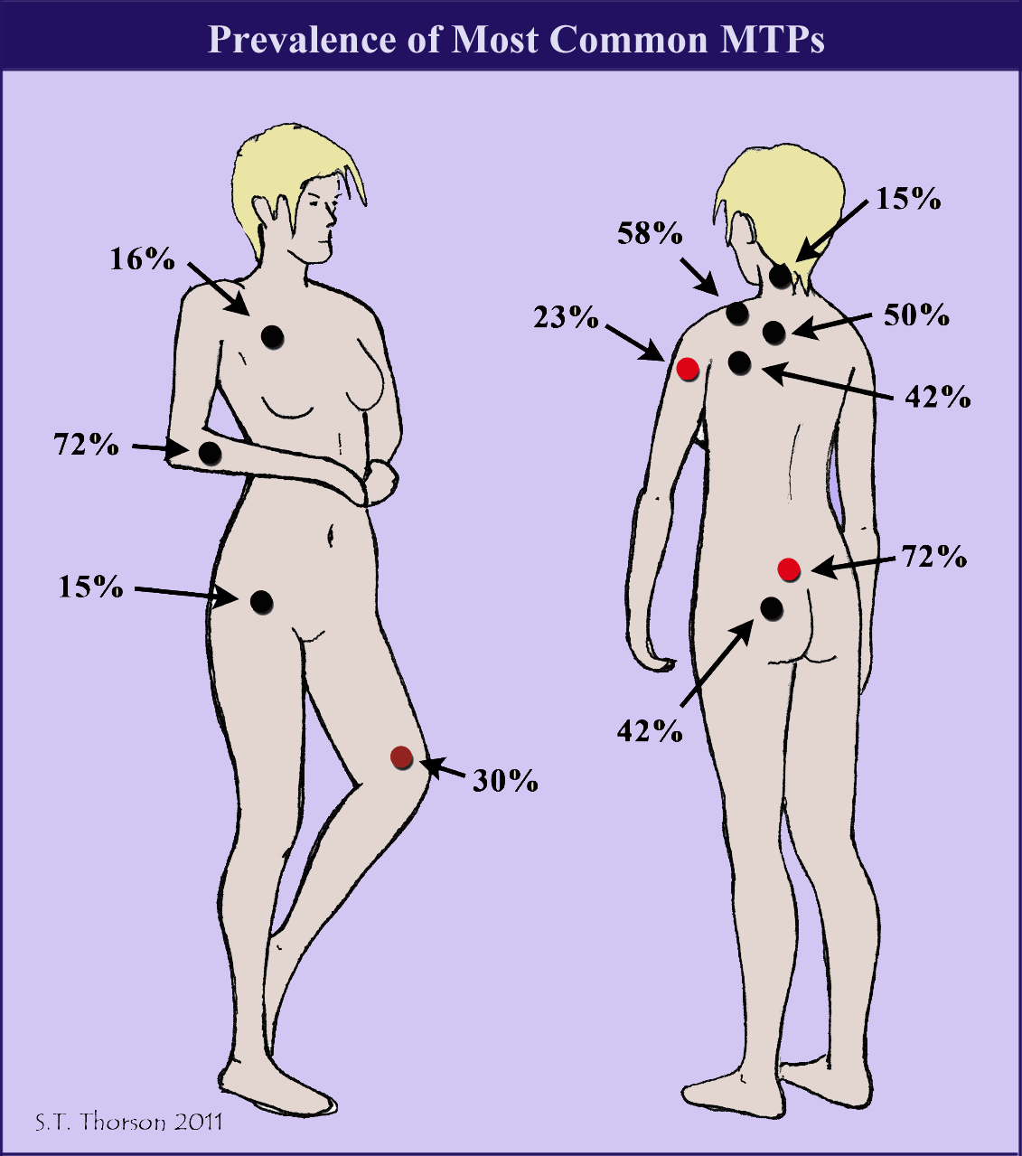Diagram showing that 90 percent of fibromyalgia tender points are active trigger points or MTPs.
