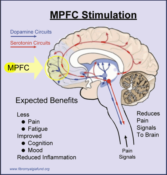 Diagram showing how TMS treatment of the medial prefrontal cortex (MPFC) will reduce fibromyalgia symptoms, change spinal cord signals and improve brain activity during reward MID task.