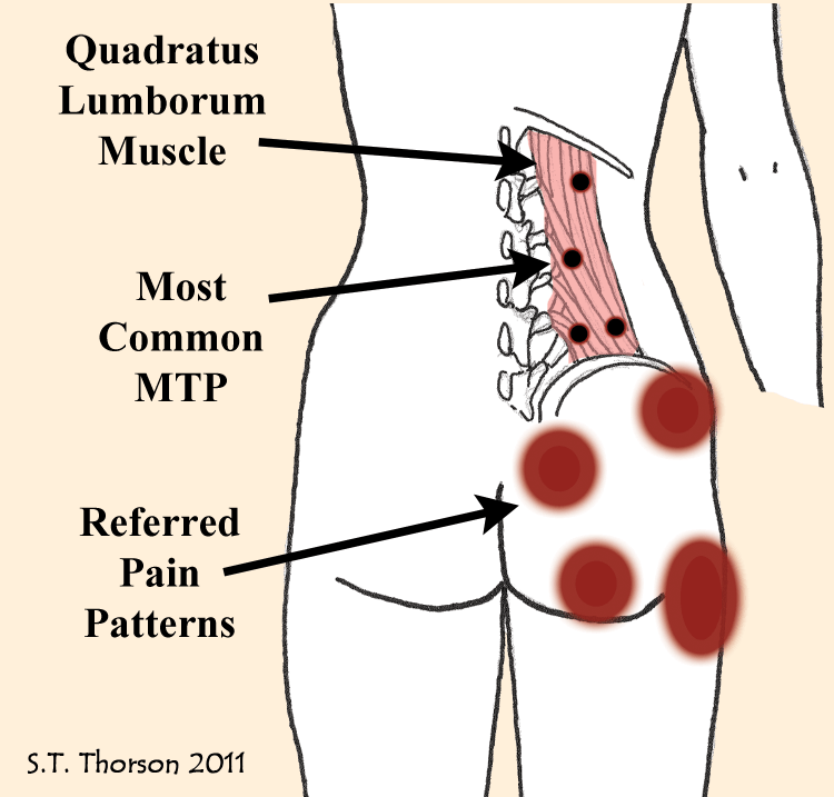 Diagram showing that trigger points in the quadratus lumborum muscle cause back pain but were not part of the tender point diagnosis in fibromyalgia.