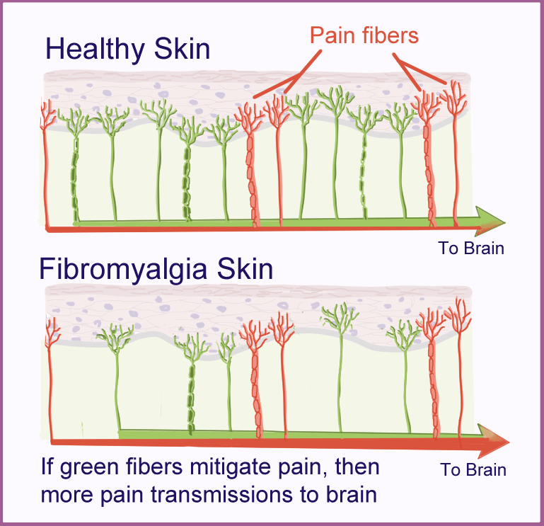 Illustration of how small nerve fiber damage in the skin of fibromyalgia patients contributes to the symptoms of the condition.