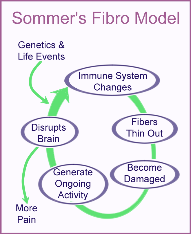 A model showing how small nerve fiber changes in fibromyalgia can cause more pain, but the process is not the same as a neuropathy, according to Claudia Sommer, M.D.