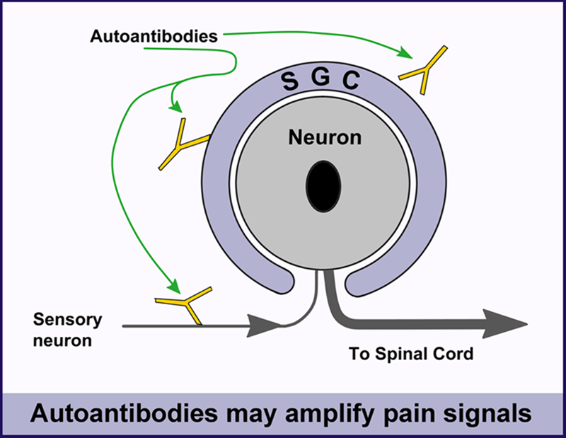 Autoantibodies may amplify pain signals to contribute to the pain of fibromyalgia.